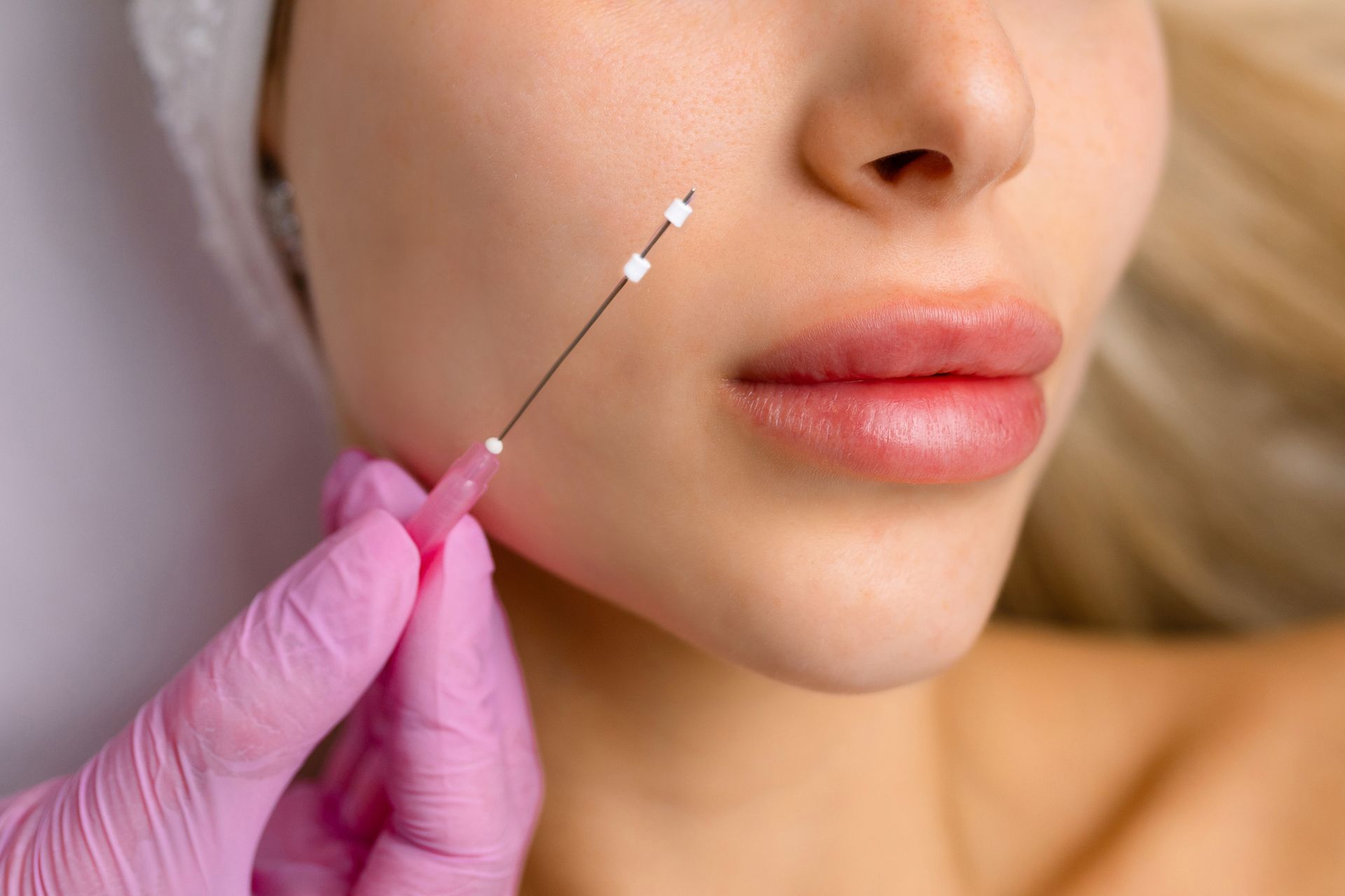 A person's face being injected with a thread lift. Pink gloves hold the needle near the cheek.