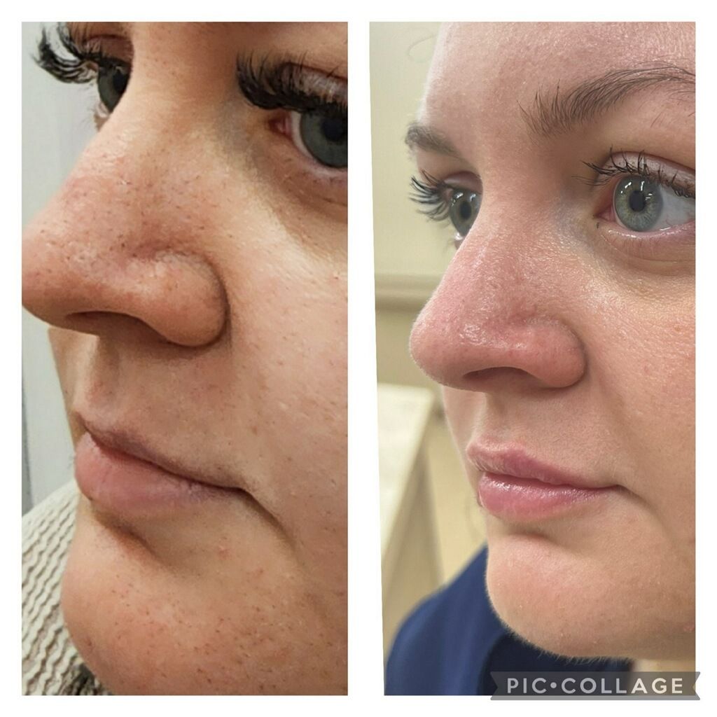 A before and after photo of a woman 's nose.