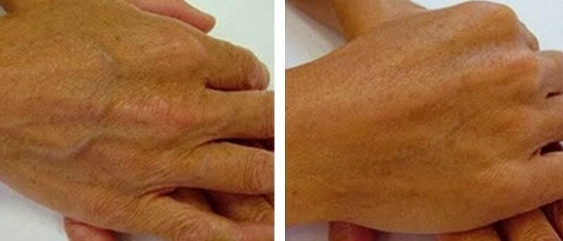 ANTES Y DESPUES