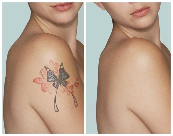 Cómo eliminar un tatuaje con láser?
