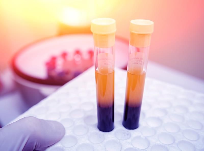 Platelet-Rich Plasma (PRP)