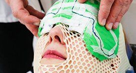 a 3d printed customise jigs as a masking jigs facial reconstruction