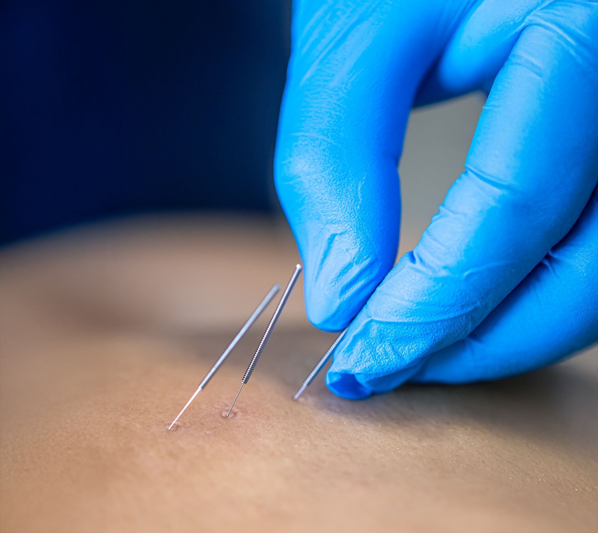 Dry needling Courtice