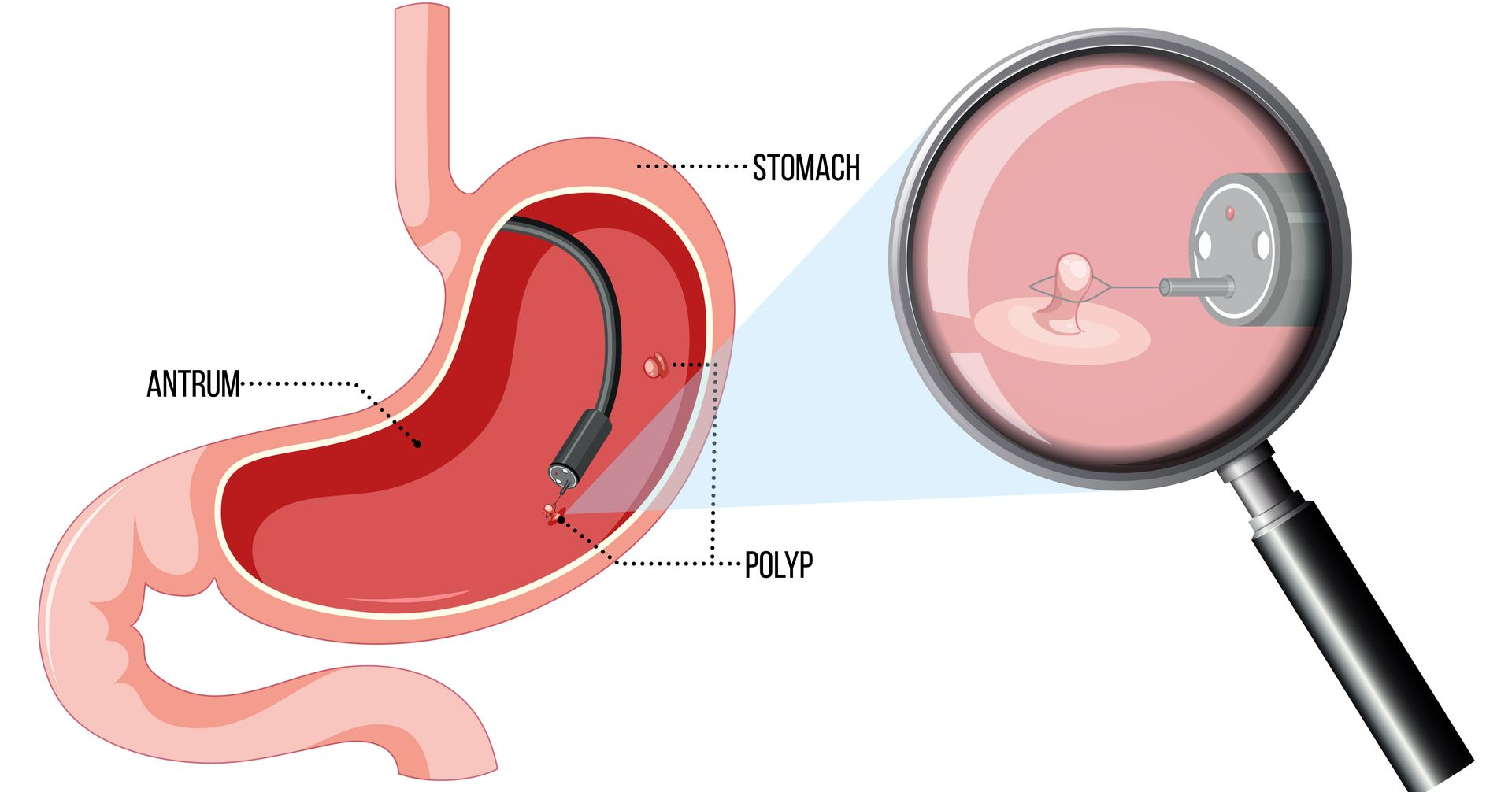 Diagram of stomach with endoscope removing a polyp. Magnified view shows polyp.