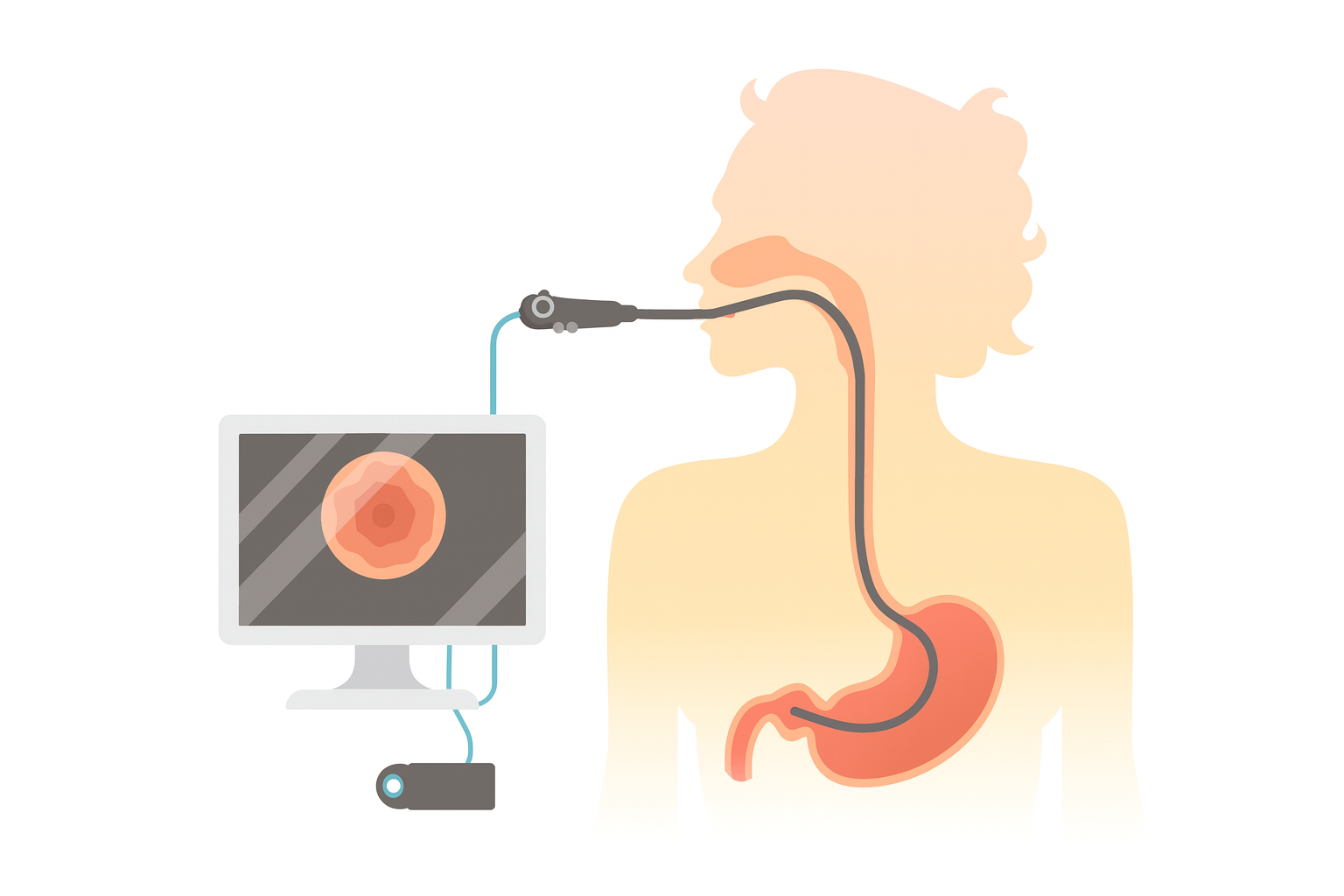 Illustration of an endoscopy procedure: a scope enters a person's mouth, with the image displayed on a monitor.