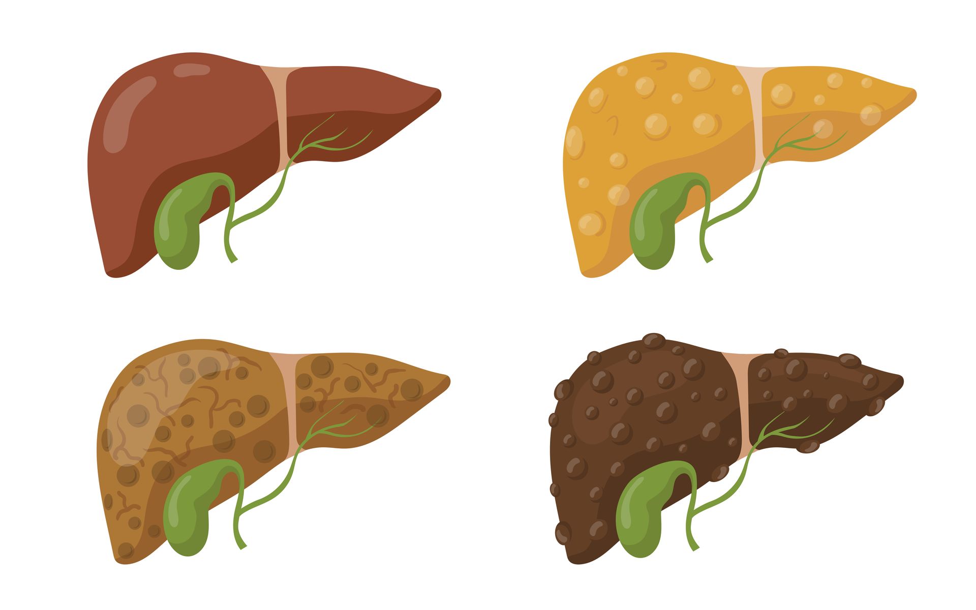 Four livers showing stages of liver disease, ranging from healthy to severe damage; illustrations.