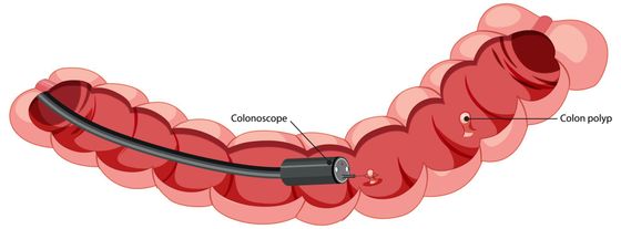 Diagram of colonoscopy procedure with scope inserted in the colon.