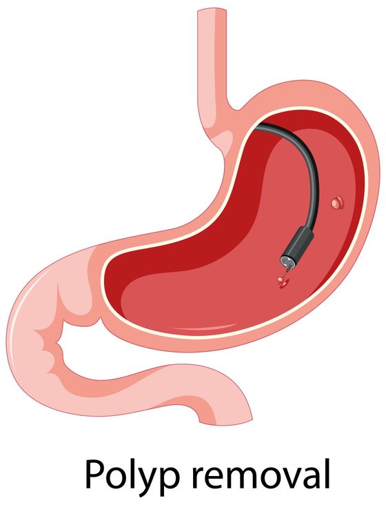 Diagram of stomach with endoscope inside, removing a polyp.
