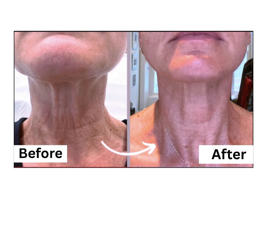 A woman is getting an injection for hair restoration.