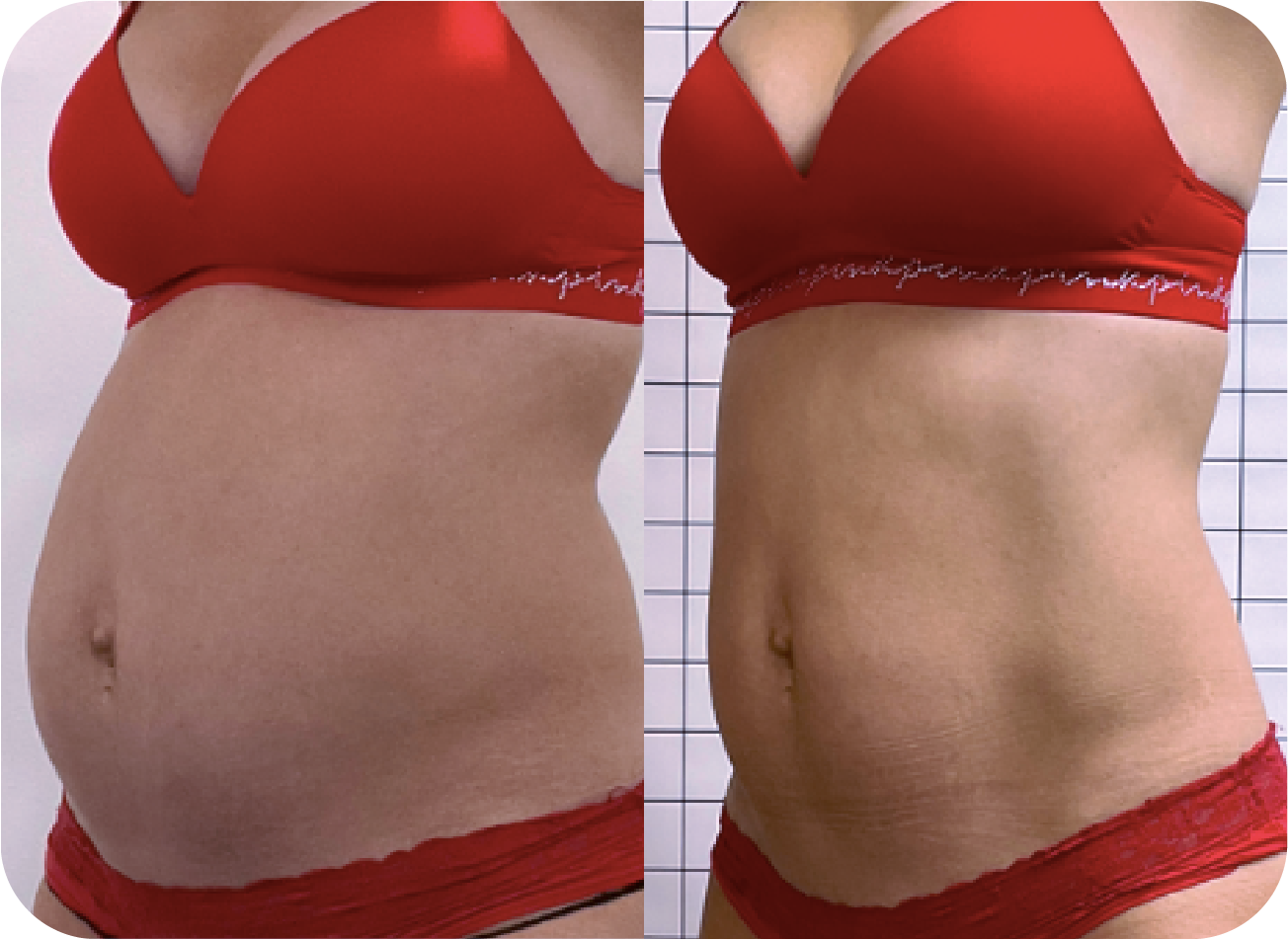 Before and after of a woman after the body shaping treatments at Holos Medical Spa.