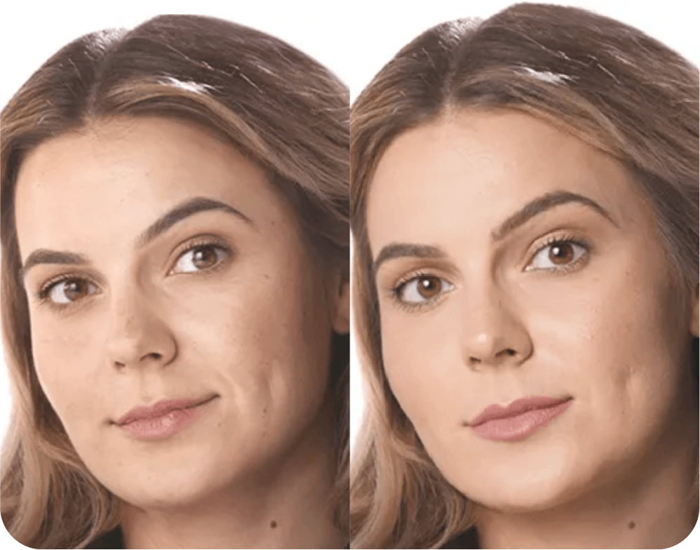 A woman 's face is shown before and after fillers offered at Holos Medical Spa.