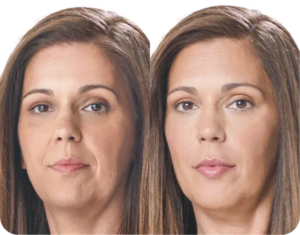 A before and after photo of a woman 's face after a dermal filler treatment.