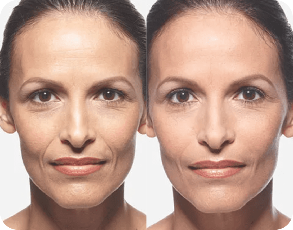 A before and after photo of a woman 's face after filler.