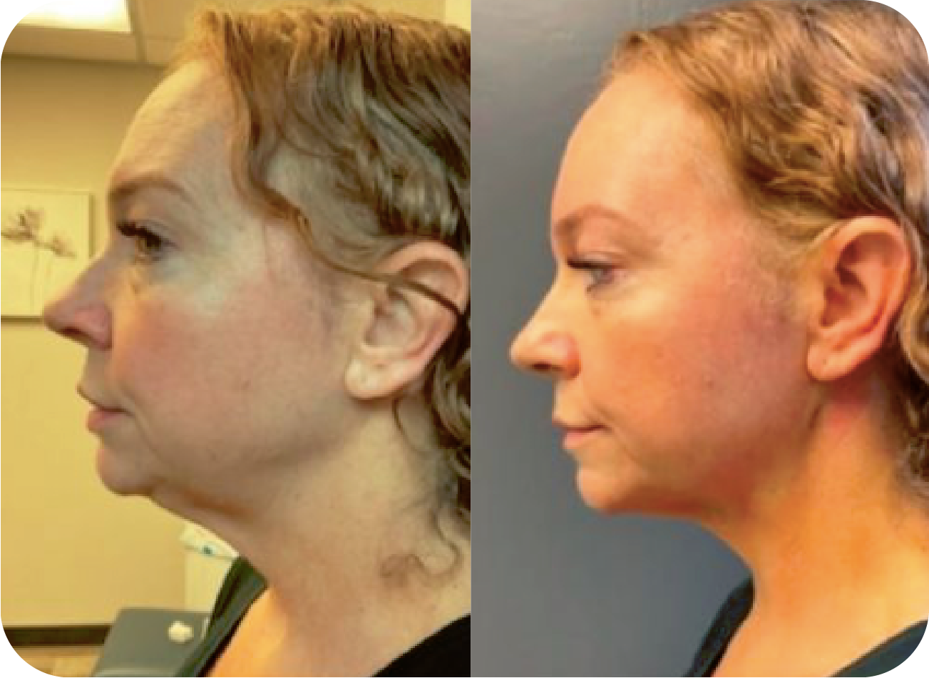 A before and after photo of a woman 's face- after PDO Threads at Holos Medical Spa.