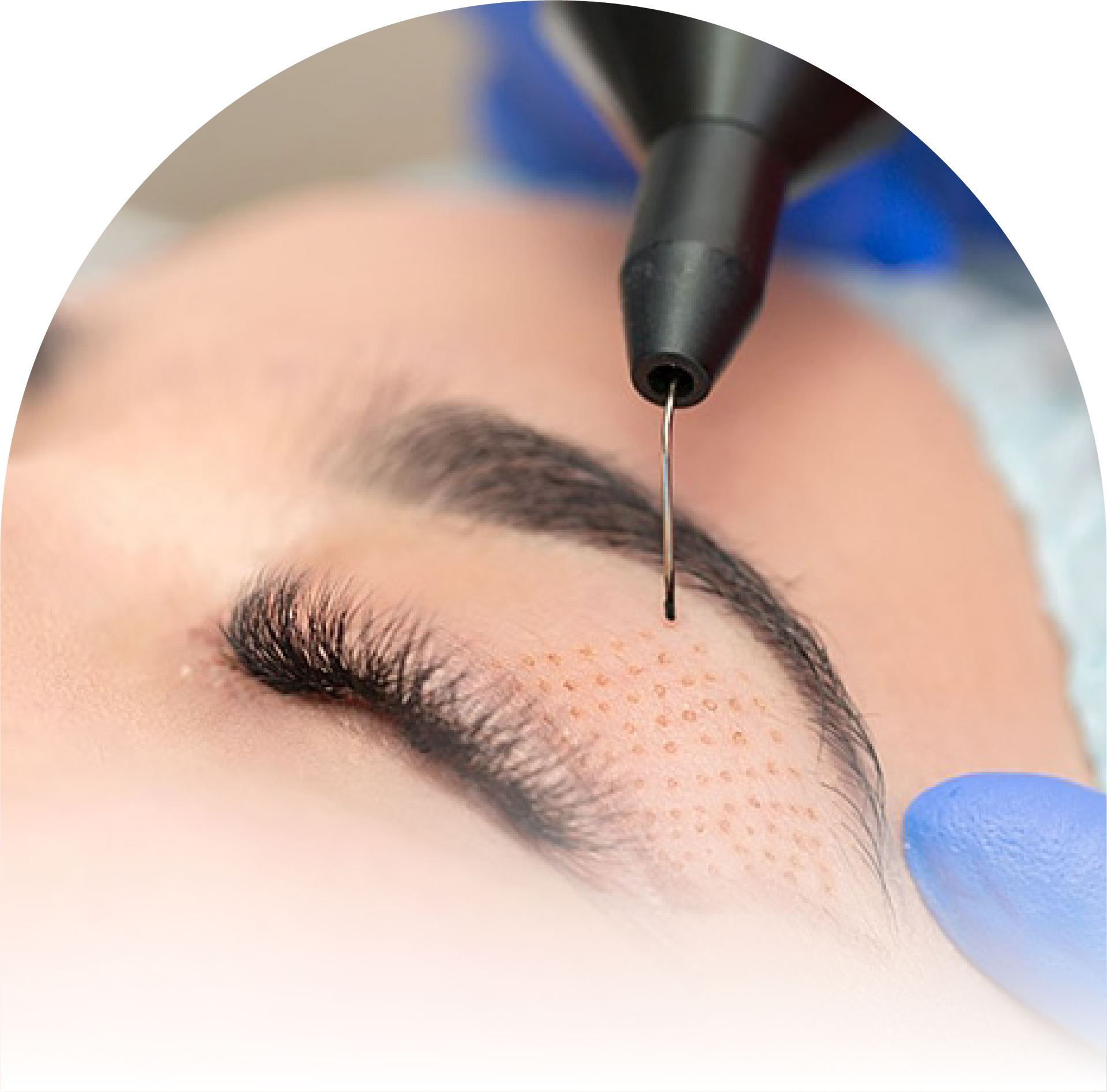 A woman is getting a Subnovii Plasma treatment on her eyebrows.