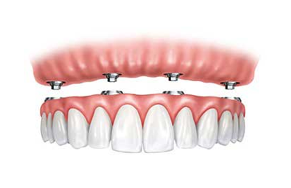 Illustration of dentures attached to dental implants in the upper and lower jaw, showing pink gums and white teeth.