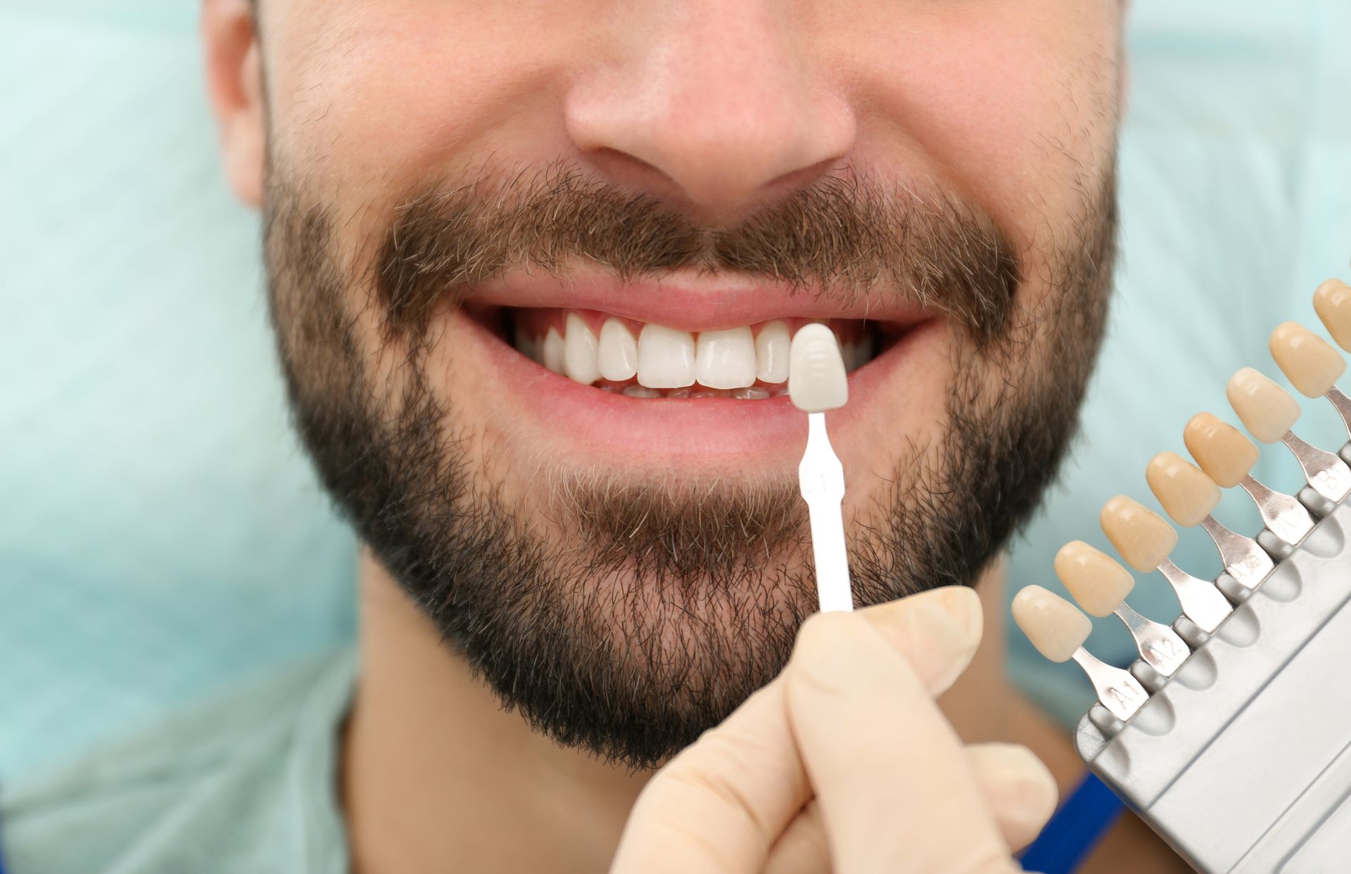 Man smiling while applying dental veneers