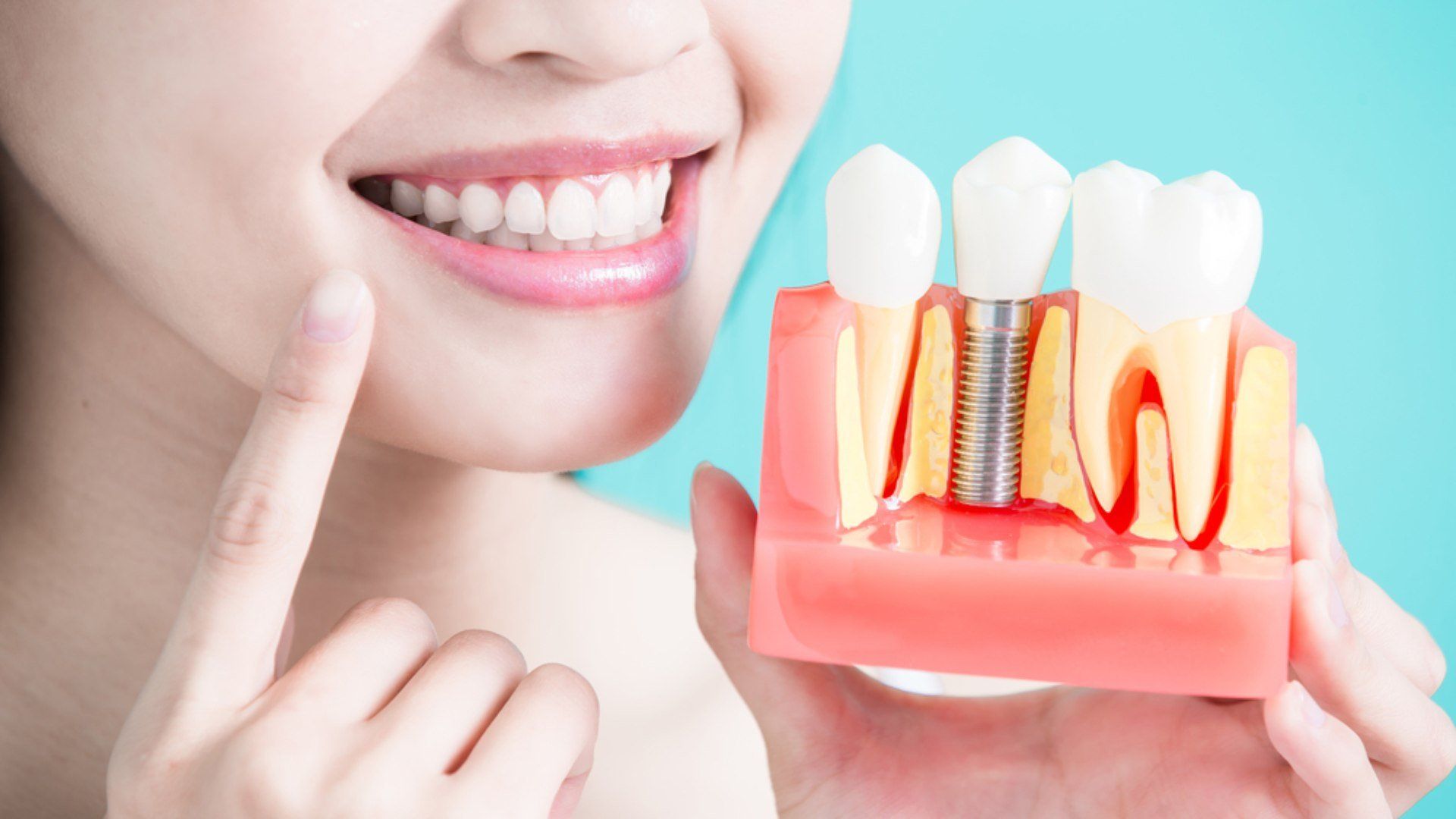 tudo sobre implantes dentarios