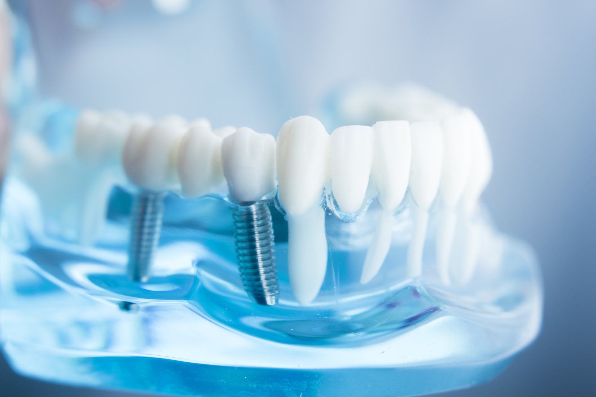 implantes
