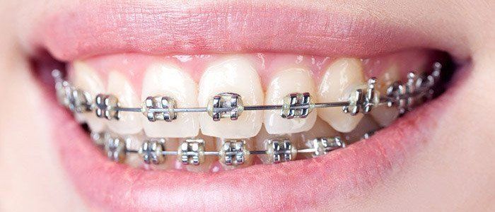 women showing her teeth with braces