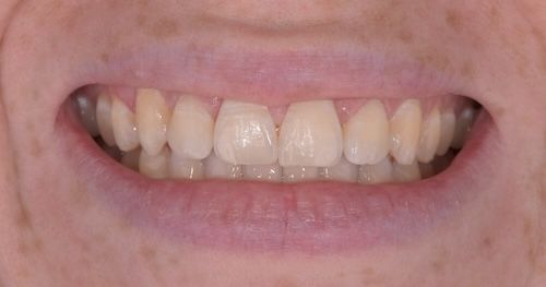Close-up of a person's smile showing teeth. Teeth are slightly yellowed with a small gap.