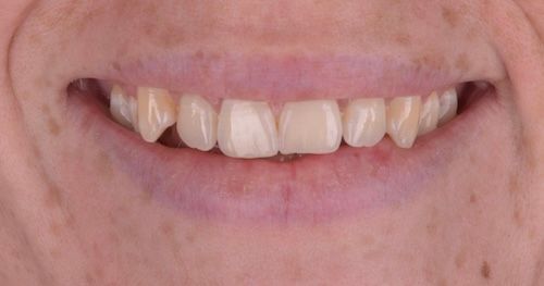Close-up of a person smiling, showing uneven, yellowed teeth. Pale skin and a pink mouth are visible.