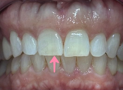 Close-up of teeth. Pink arrow points to a gap between the front two teeth.
