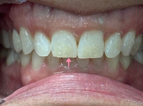 Close-up of a mouth with teeth; the central teeth are slightly discolored. An arrow points at the small space between them.