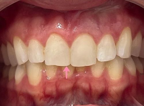 Close-up of teeth with an arrow pointing to a small gap between the lower front teeth.