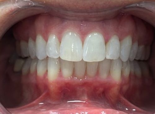 Close-up of healthy teeth, showing bright white color and aligned structure within a mouth.