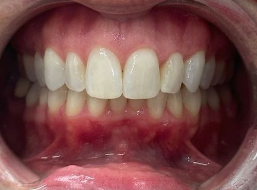 Open mouth view of healthy teeth, with slightly red gums and visible tongue.