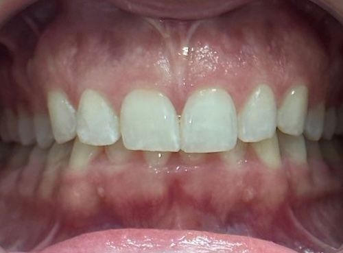 Close-up of a person's teeth, showing white, healthy teeth and pink gums.