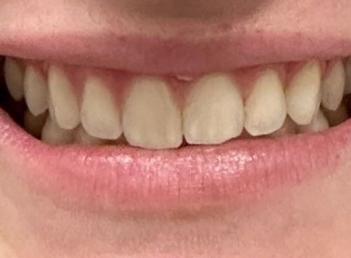 Close-up of a person's smiling mouth, showing upper and lower teeth and pink lips.