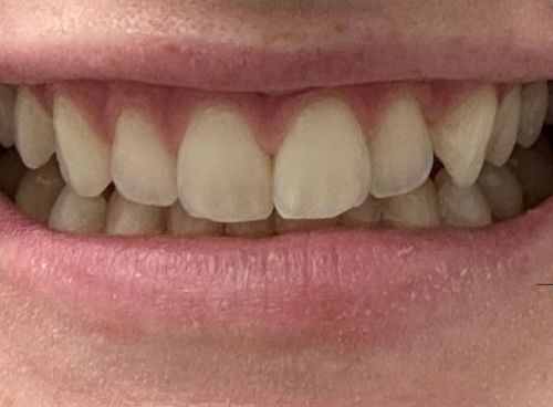 Close-up of a person's smiling mouth, showing teeth and pink gums. The teeth are generally straight and slightly yellowed.