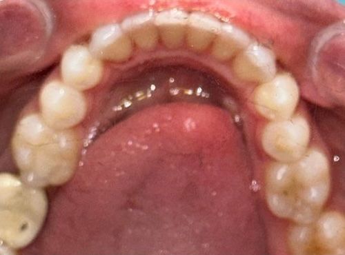 Close-up of upper teeth and gums, showing the tongue, with slightly yellowed teeth and some fillings.