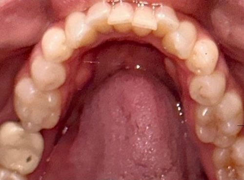 Close-up view inside a mouth, showing upper teeth with braces, tongue, and the roof of the mouth.