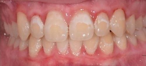 Close-up of a person's teeth. Some teeth show white spots against the pale, yellowish color of the tooth enamel.