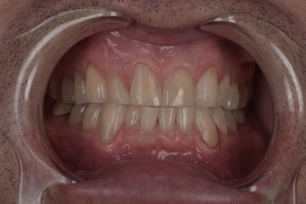 Mouth open, teeth visible. Dental examination with a retractor in place; gums and teeth are in view.