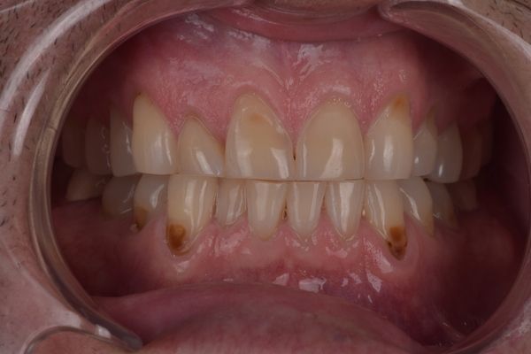 Close-up of a person's teeth showing yellowing and brown spots near the gum line, within an open-mouth retractor.