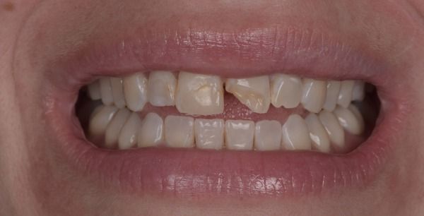 Close-up of teeth; some are slightly misaligned, with small spaces between them.