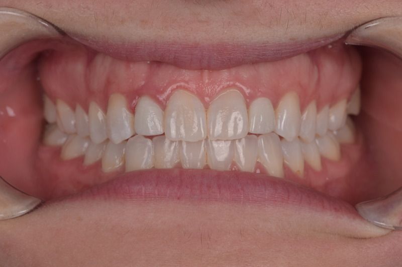 Close-up of a person's teeth. White, straight teeth with pink gums, held open by retractors.
