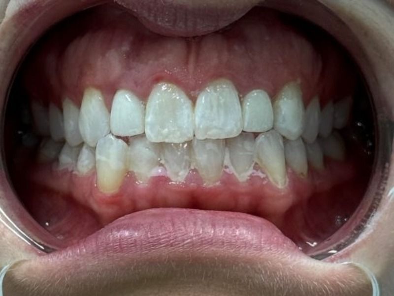 Close-up view of teeth in a mouth, revealing white and slightly uneven teeth.