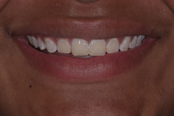 Close-up of a person's smiling mouth showing white teeth. The central teeth have a slight discoloration.