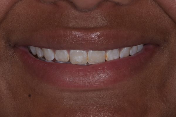 Close-up of a smiling mouth with white teeth and light discoloration on one tooth.