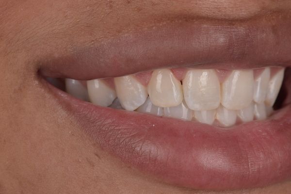Close-up of a person's smiling mouth showing several white teeth.