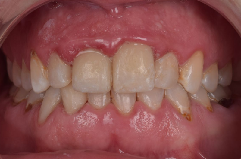 Close-up of teeth, showing worn enamel, yellowing, and some gum inflammation.