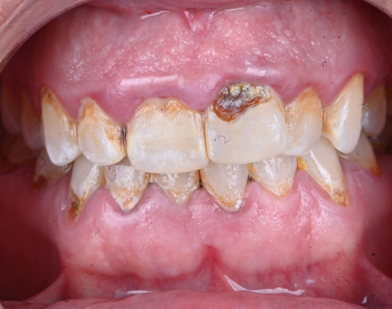 Close-up of mouth with severely decayed, yellowed teeth; some teeth have visible cavities.