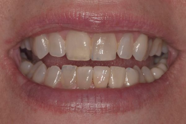 Close-up of teeth, showing worn enamel, yellowing, and some gum inflammation.