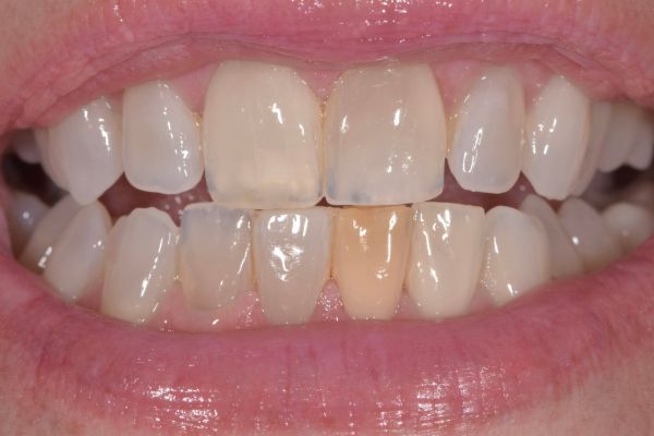 Close-up of mouth with severely decayed, yellowed teeth; some teeth have visible cavities.