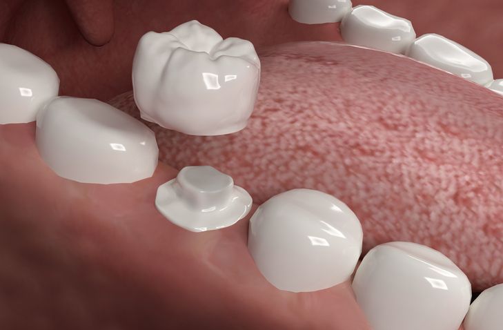 Dental crowns fitting on teeth, inside a mouth.
